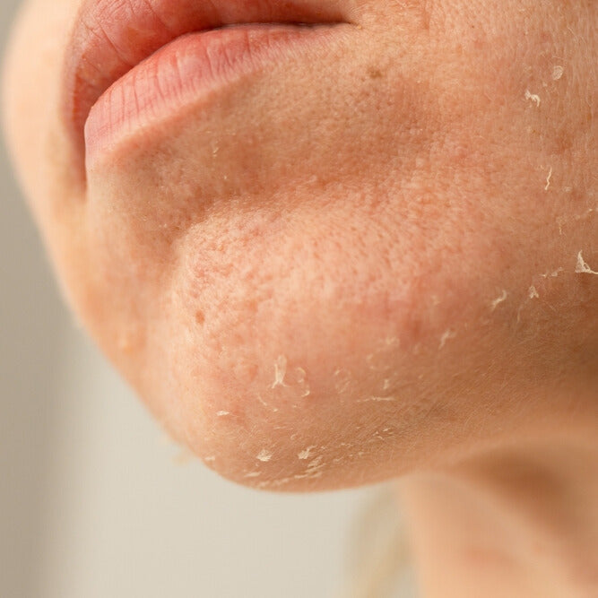 Skincare producten voor onzuivere huid, aanpak van acne en verstopte poriën